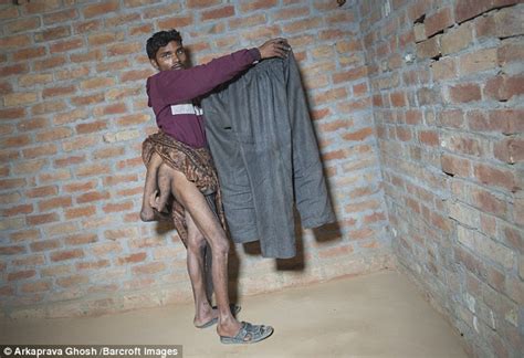 Indian Arun Kumar With Four Legs Pleads For Doctors To Remove The Extra