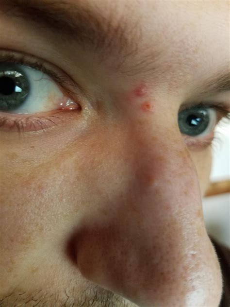 How to get rid of acne. new acne between eyebrows? - General acne discussion ...