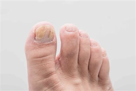 An Overview Of Common Toenail Problems