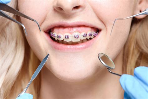 10 Tips To Make Living With Braces Easier Markham Orthodontics