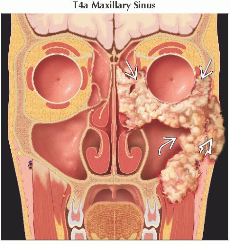 Cancer Of The Nasal Cavity And The Paranasal Sinuses Oncohema Key My