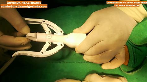 Zsr Circumcision And Frenuloplasty New Delhi India Dr Vijayant