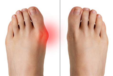 All You Need To Know About Bunions And Hammertoes