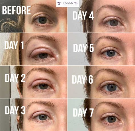 Upper Blepharoplasty Before And After Gallery Taban Md