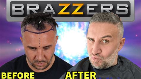 Brazzers P Rn Star Keiran Lee Gets A Hair Transplant Youtube