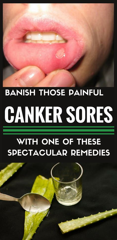 Banish Those Canker Sores With One Of These Spectacular Remedies