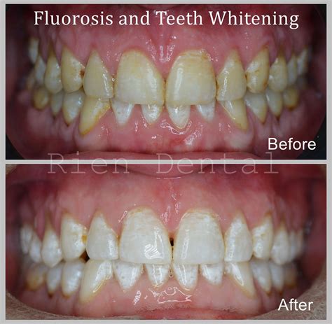 Fluorosis And Teeth Whitening