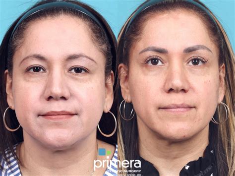 Buccal Fat Removal Before And After Pictures Case 784 Orlando