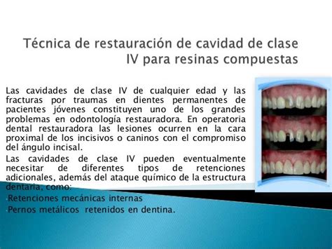 Técnica De Restauración De Cavidad De Clase Iv