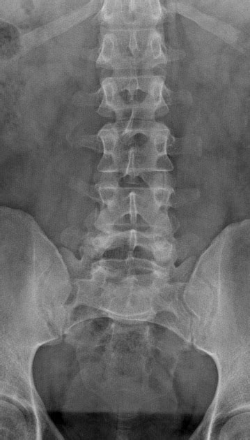 Lumbar Spine Xray Anatomy