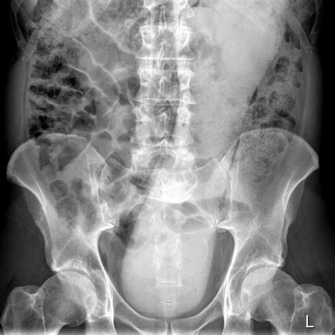Rectal Foreign Bodies Radiology Reference Article Corpo Umano Pazzi Corpo