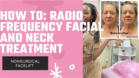 How To Radio Frequency Face And Neck Treatment Facial Before And After