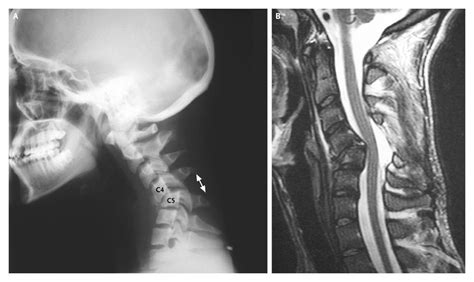 Dislocation Of The Cervical Spine — Nejm