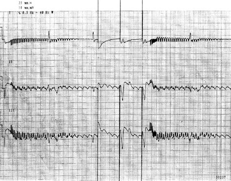 Pacemaker Malfunction Litfl Ecg Library Diagnosis