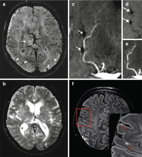 Resolution Imaging Of Cerebral Small Vessel Disease With 7 T Mri