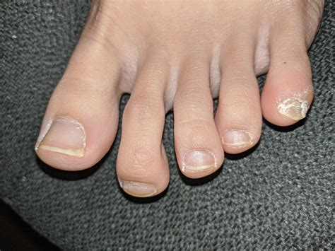 Toenail Fungus Always Thought My Toes Were Just Gross Because My Pinky