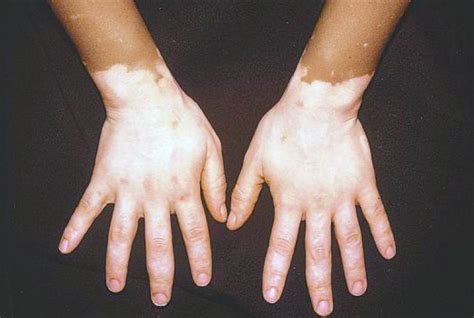 Macular Depigmentation Vitiligo Dermatology Images Dermatology