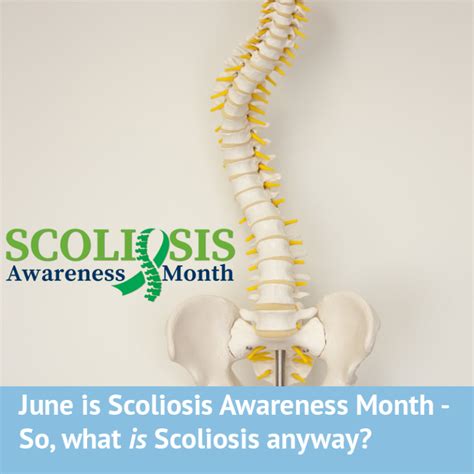 Scoliosis Screening Archives Scoliosis Clinic Uk Treating Scoliosis