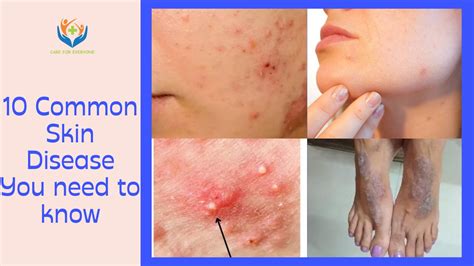 The 10 Most Common Skin Diseases And How To Treat Them Images And