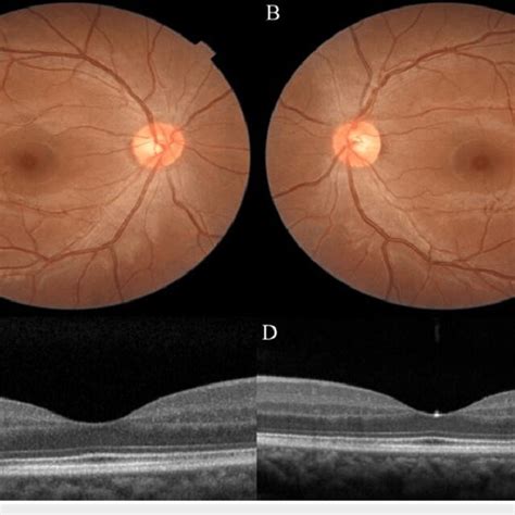 Fundus Photo Of The Right Eye A And Left Eye B During The Follow Up