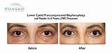Prp Eye Treatment