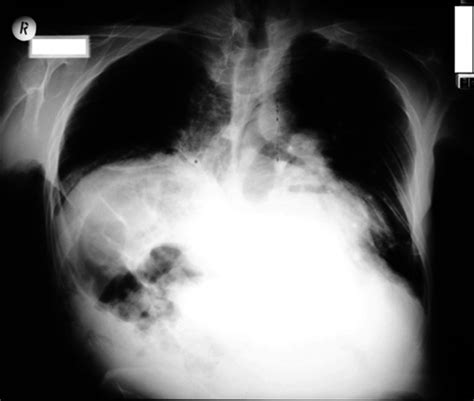 Chest X Ray Of The Patient With Hypertrophic Cardiomyopathy And