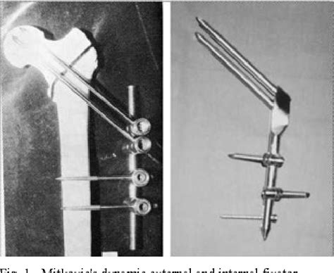 Figure 1 From Surgical Treatment Of The Trochanteric Fractures By Using