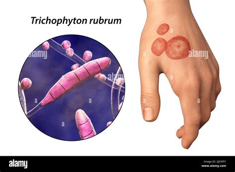 Fungal Infection Rash Tinea On Hi Res Stock Photography And Images Alamy