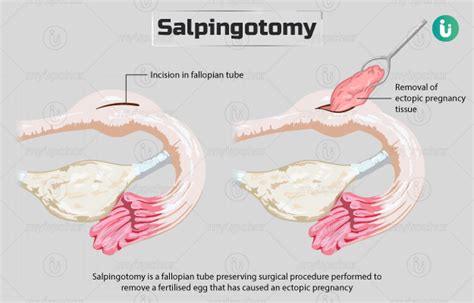 Salpingotomy Procedure Purpose Results Cost Price Indications Recovery