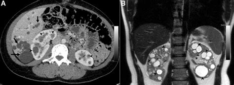 Autosomal Dominant Polycystic Kidney Disease Adpkd A A 39 Year Old
