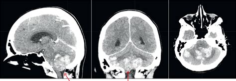 A Case Of Her2 Positive Breast Cancer With Rapidly Progressing Cns