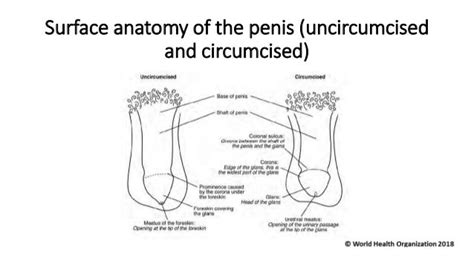Male Circumcision Under Local Anaesthesia By Dr Grothuesmann And Sr Win