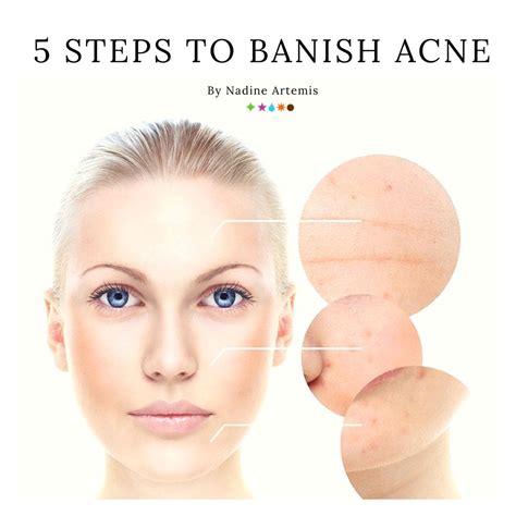 Diet Hormones And Acne Oh My 5 Steps To Banish Acne Acne Skin