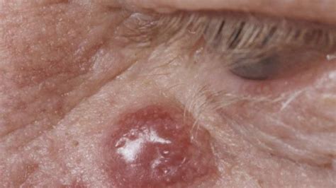 Merkel cell carcinoma is an especially deadly form of skin cancer that's hard to spot. Skin Cancer Rash: Itchiness and Symptoms