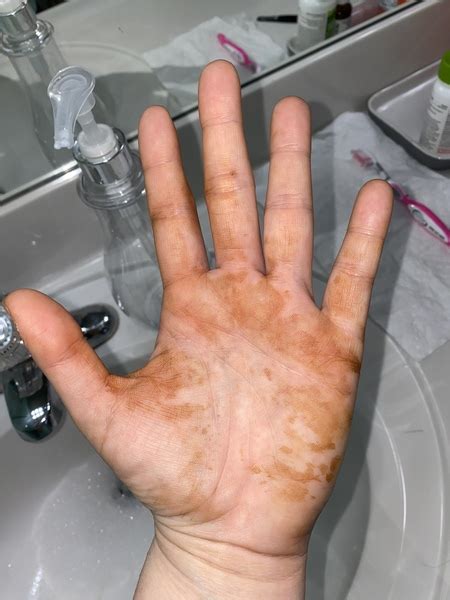 What Are These Orange Stains That Have Appeared On My Hands Overnight