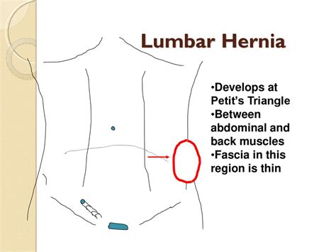 Abdominal Wall Hernias Online Presentation
