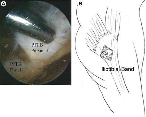 Endoscopic Iliotibial Band Release For External Snapping Hip Syndrome