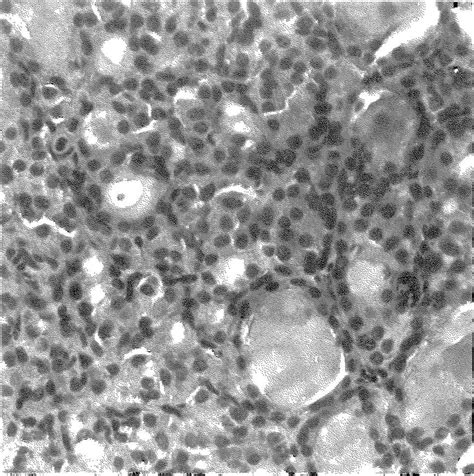 Hyperplasia Of C Cells In The Thyroid Gland From A Dog With A