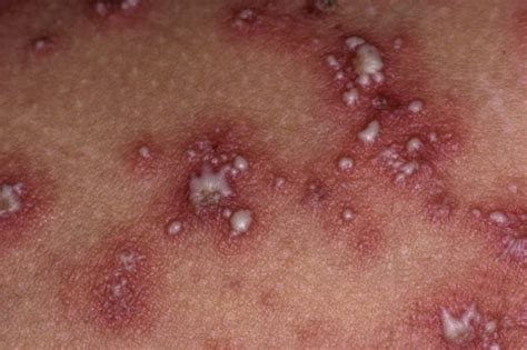 Pustular Psoriasis Clinical And Genetic Differences Between Subtypes