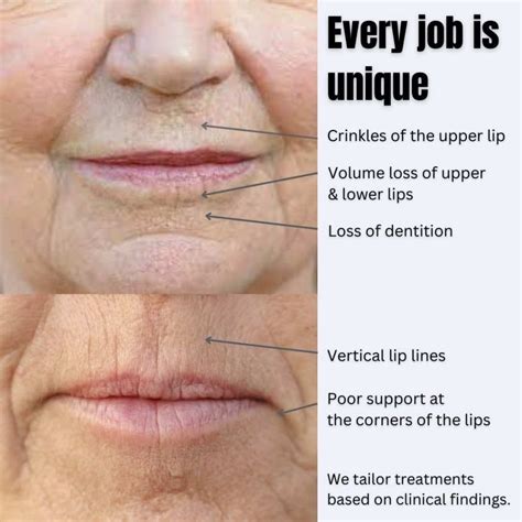 Best Upper Lip Lines Treatment In Australia Dr Davin Lim