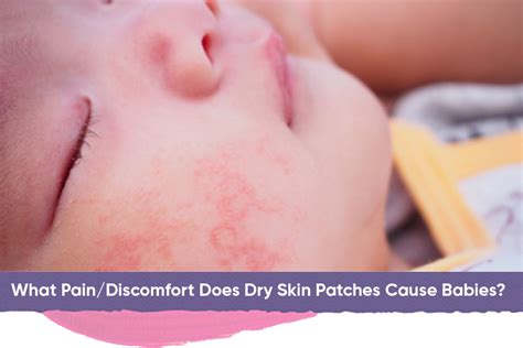 Baby Dry Skin Patch Leading Causes Treatments And Natural Remedies