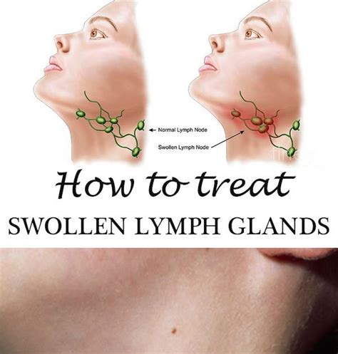 How To Treat Swollen Lymph Glands Top Beauty Enhancer