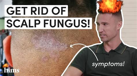 Scalp Infection A Doctor Explains How You Get Scalp Fungus And How To Treat It Youtube
