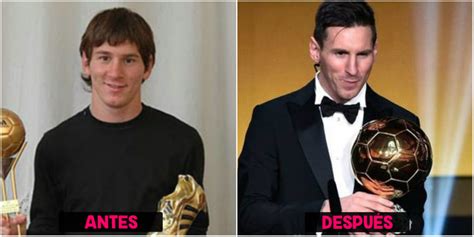 Cirugías De Messi Antes Y Después Cirugiasde