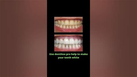 how to make my teeth white whitened at the dentist how to make your teeth white fast short