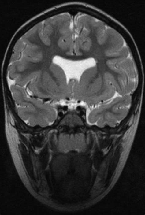 Brain Coronal Section Showing Agenesis Of Septum Pellucidum Figure 2