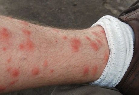 What Causes Rash On Legs Pictures Photos