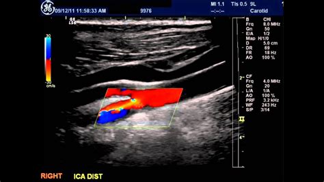 Carotid Doppler With Plaque Ulcer Youtube