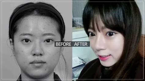 Korean Plastic Surgery Before And After Double Eyelids Rhinoplasty