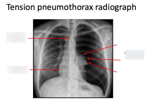 Tension Pneumothorax Radiograph Diagram Quizlet